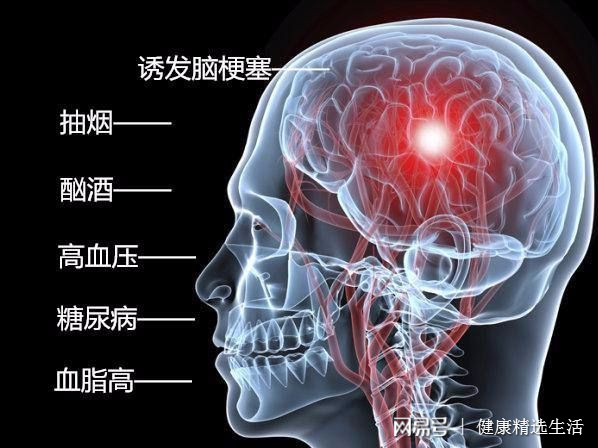 女教师突发脑梗背后的筋膜枪隐患揭秘